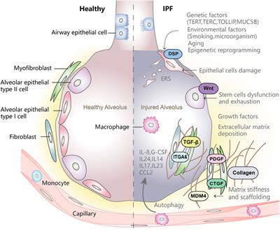 Idiopathic Pulmonary Fibrosis: An Update on Pathogenesis